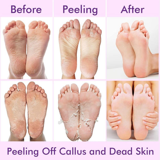 Dead Skin Remover Foot Mask – Reveal Baby-Soft Feet